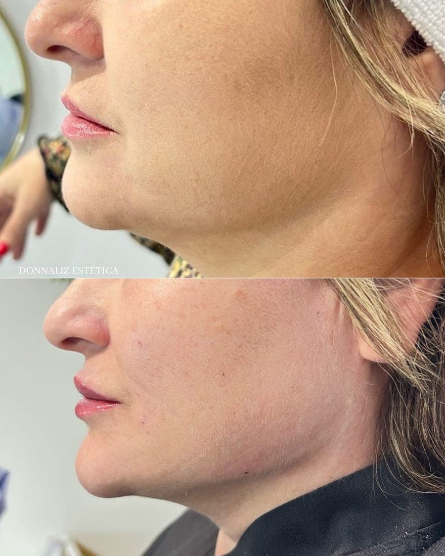 Perfil do rosto antes, em cima, e depois, embaixo, com o contorno do queixo mais definido