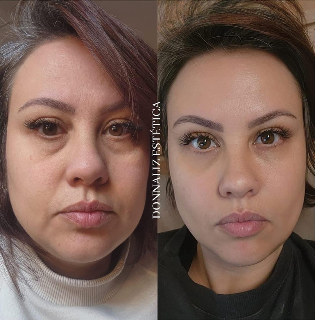 Rosto de frente antes e depois da harmonização facial