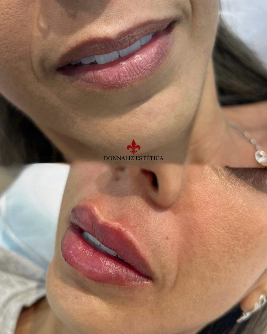 Lábios antes, em cima, e depois do preenchimento, embaixo
