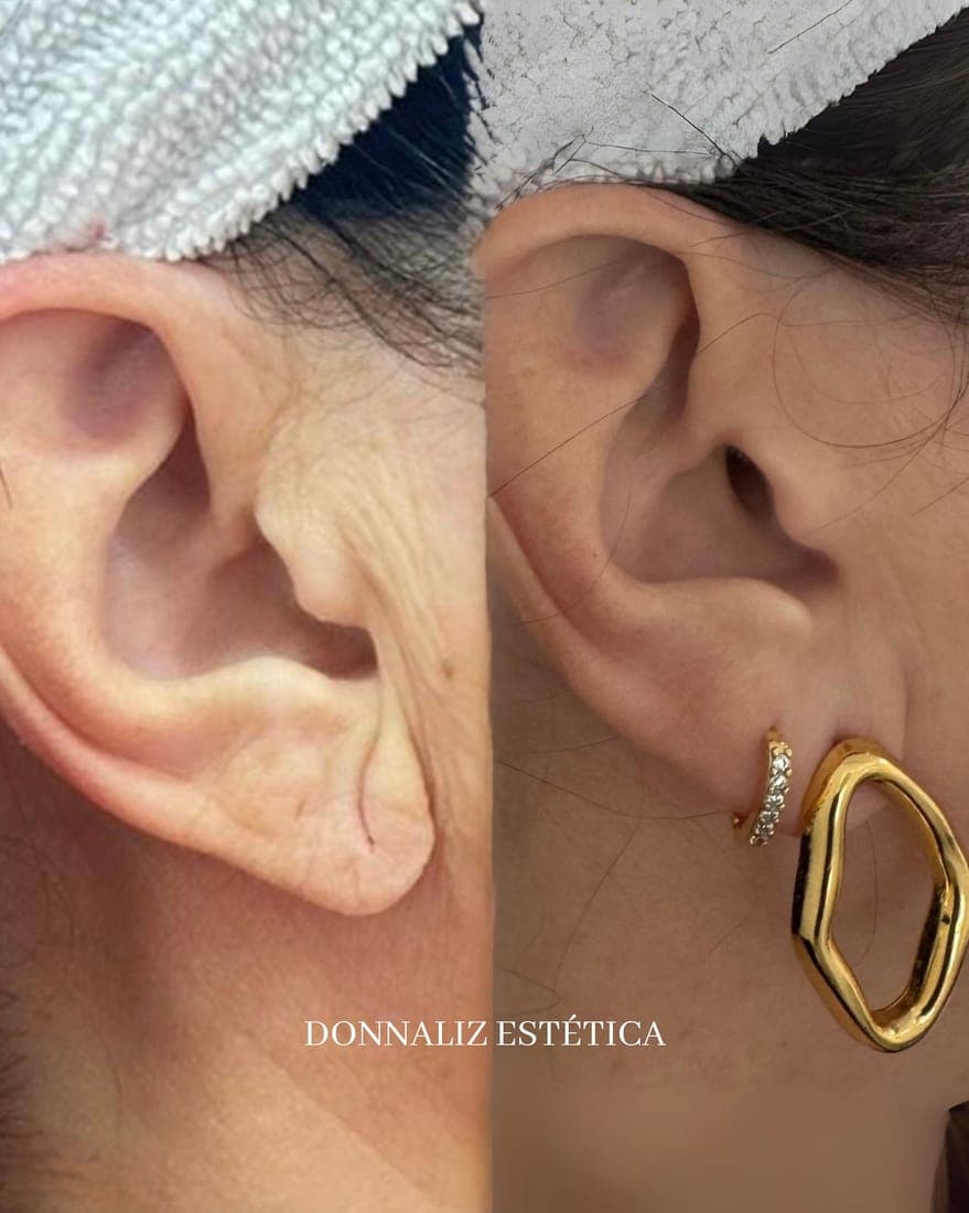 Lóbulo da orelha antes, à esquerda, e depois do preenchimento, à direita