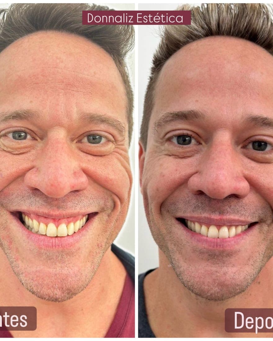 Homem sorrindo antes e depois, com menos linhas em volta dos olhos